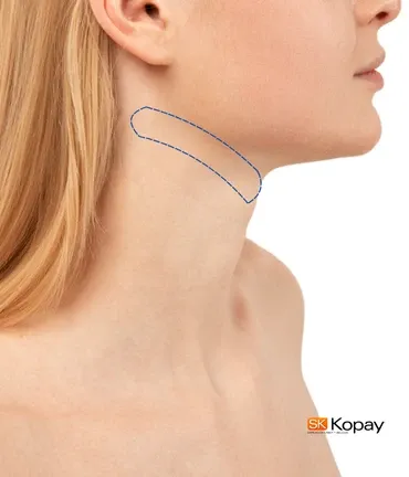 Extensión de Cuello